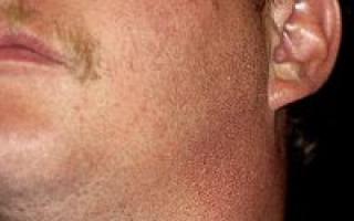 Pubic lice (pubic lice): where you can get infected, signs, how to recognize, treatment